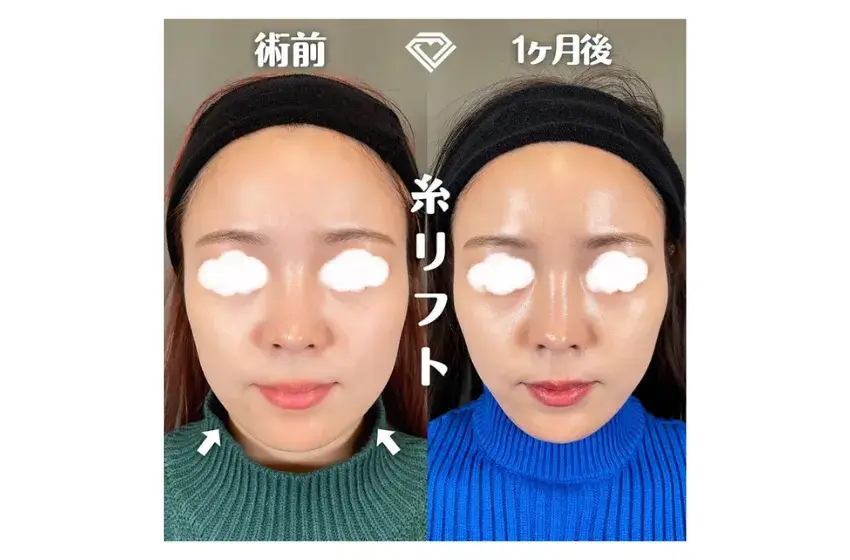 TCB東京中央美容外科　糸リフト　症例写真